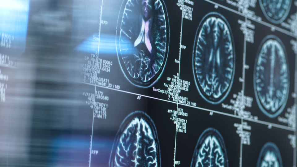 Scientists say it is possible to protect aging brain against Alzheimer’s with an old remedy – Lithium